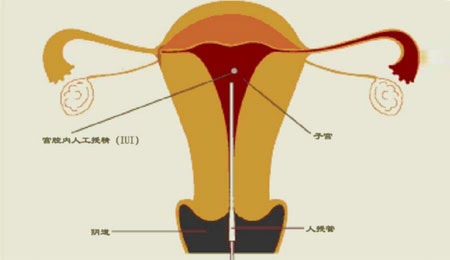 人工代孕