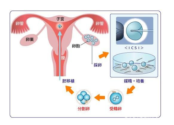 人工代孕