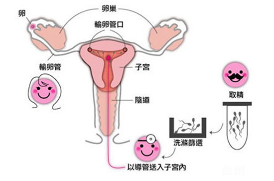 人工助孕