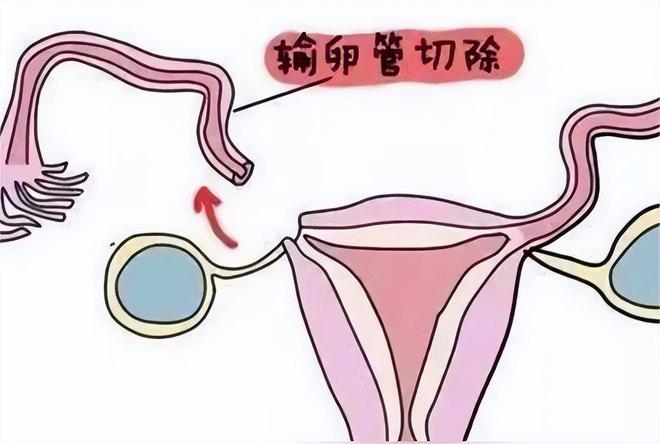 人工受精