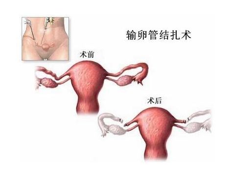 人工代孕