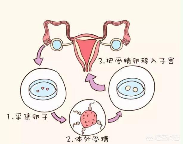 人工助孕